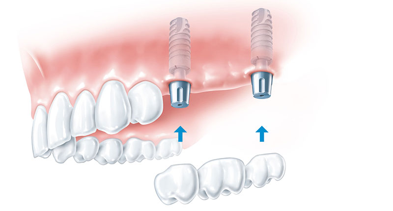Maxillary implants with a bridge on top.