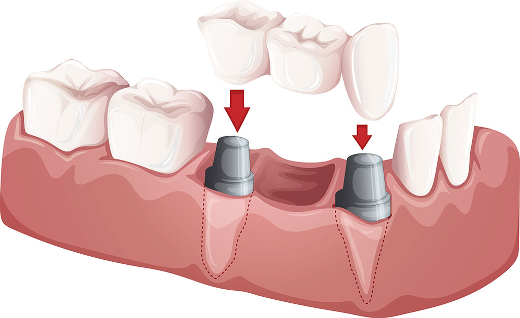 Mandibular implants with a bridge on top.