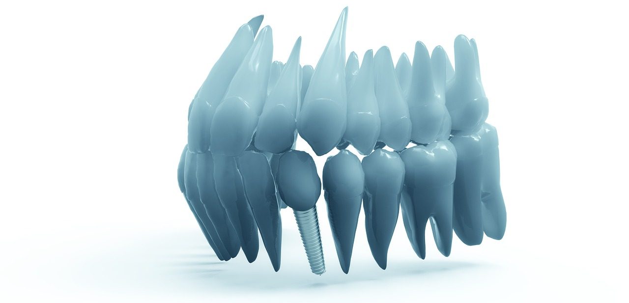 Dental Implant