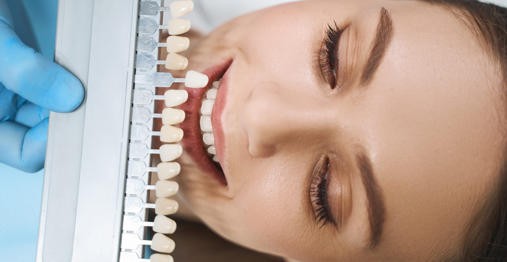 Dental Veneers Cosmetic Veneers
