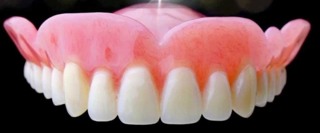 Maxillary Dentures