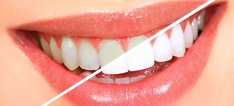 A brighter smile through teeth whitening.